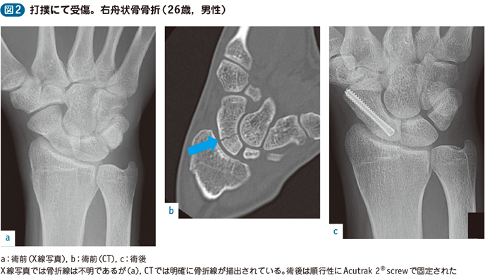 15_61_舟状骨骨折