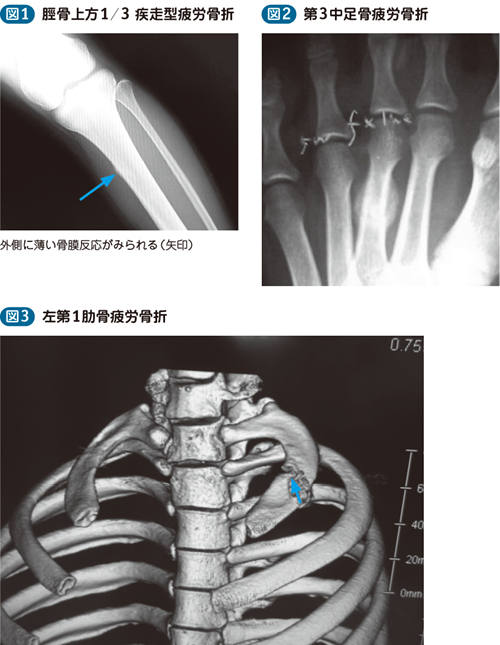 15_63_疲労骨折