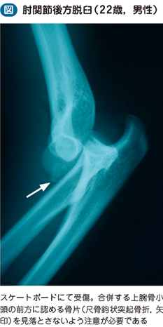 肘関節脱臼 電子コンテンツ 日本医事新報社