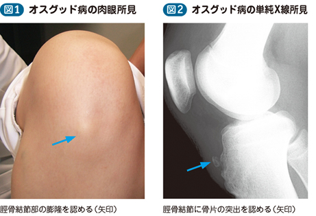 15_78_オスグッド・シュラッター症候群
