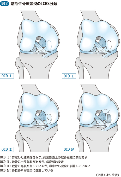15_79_膝離断性骨軟骨炎