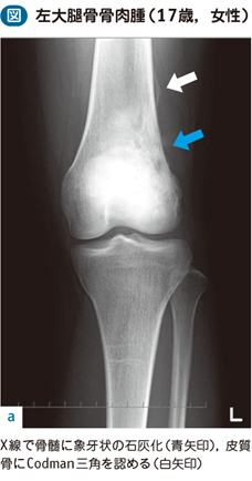 15_80_悪性骨腫瘍