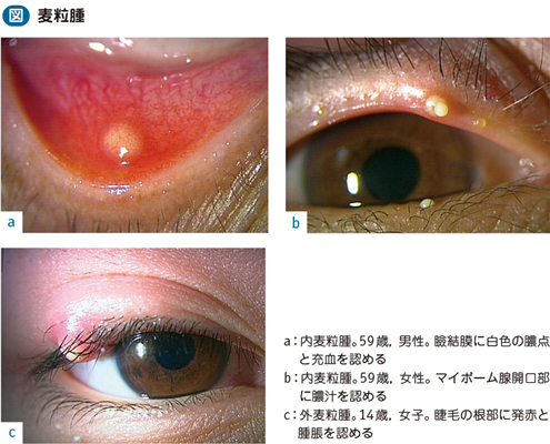 麦粒腫 電子コンテンツ 日本医事新報社