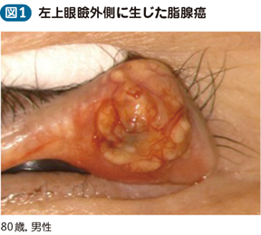 17_09_眼瞼腫瘍