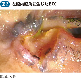 17_09_眼瞼腫瘍