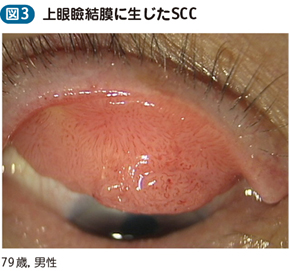 17_09_眼瞼腫瘍