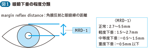 17_10_眼瞼下垂