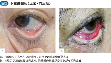 眼瞼内反症 電子コンテンツ 日本医事新報社