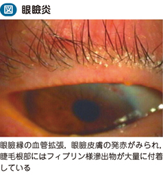 17_14_眼瞼炎（眼瞼縁炎，眼瞼皮膚炎）