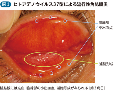 方 結膜炎 治し