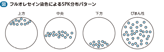 17_23_点状表層角膜症