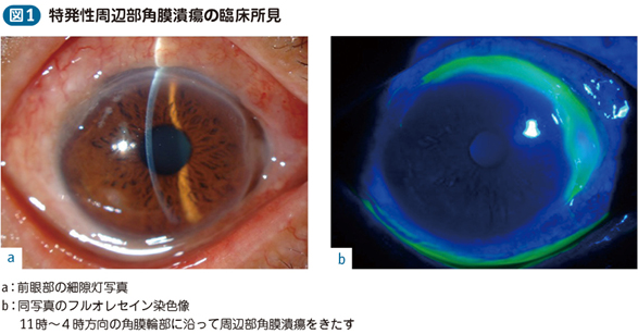 17_26_特発性周辺部角膜潰瘍