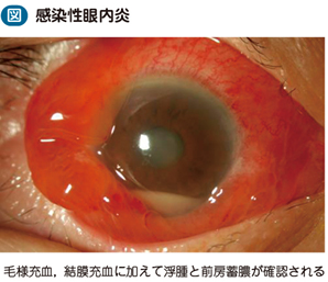 感染性眼内炎 電子コンテンツ 日本医事新報社