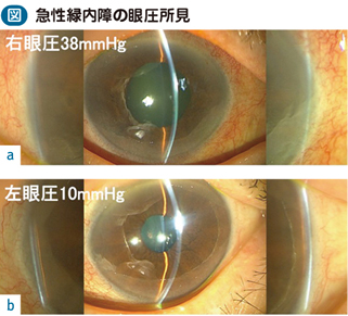 17_38_急性緑内障