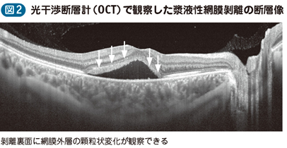 17_46_中心性漿液性脈絡網膜症