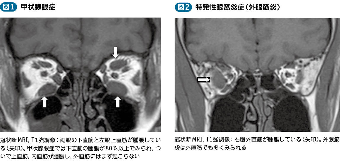 17_61_複視