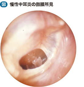 18_14_慢性中耳炎