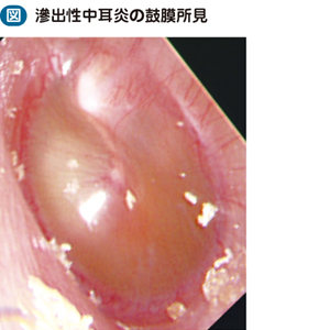 18_15_滲出性中耳炎