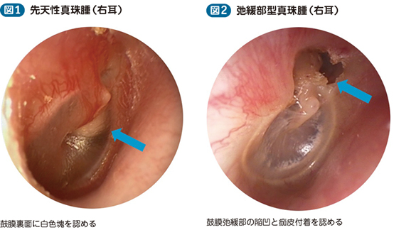 18_17_真珠腫性中耳炎