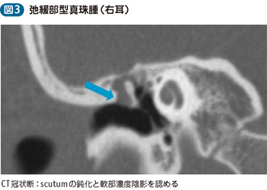 18_17_真珠腫性中耳炎