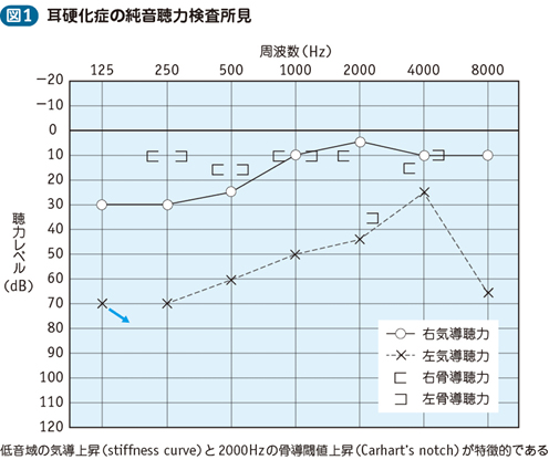 18_18_耳硬化症