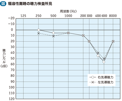 18_23_音響外傷，騒音性難聴