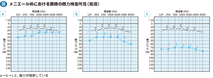 18_29_メニエール病