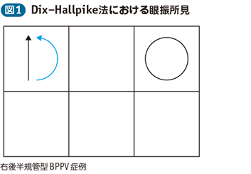 18_31_良性発作性頭位めまい症