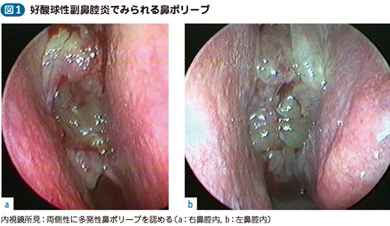 耳 管 開放 症 難病 指定