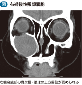 18_40_副鼻腔嚢胞