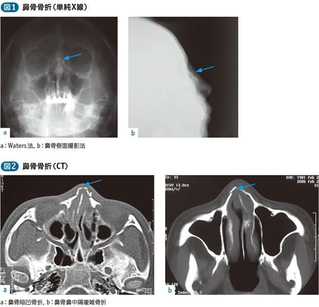 鼻骨骨折 電子コンテンツ 日本医事新報社