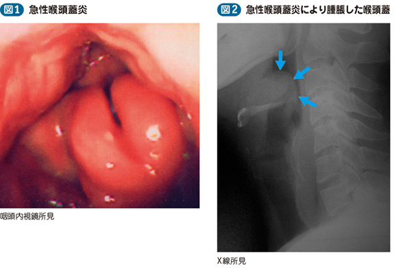 18_50_急性喉頭蓋炎