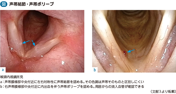 18_53_声帯結節・声帯ポリープ