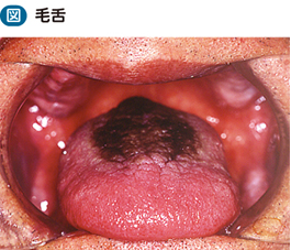 舌 黒毛 黒毛舌をご存知ですか？ 予防と治療法