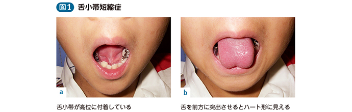 舌小帯短縮症 電子コンテンツ 日本医事新報社