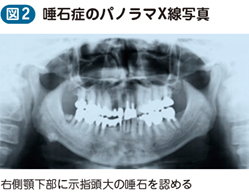 唾石症｜電子コンテンツ日本医事新報社