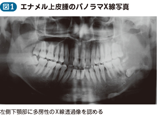 19_15_顎骨腫瘍（エナメル上皮腫）