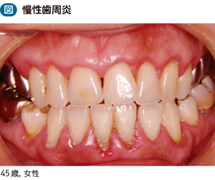 慢性歯周炎 電子コンテンツ 日本医事新報社