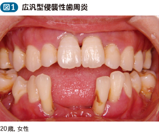 19_19_侵襲性歯周炎