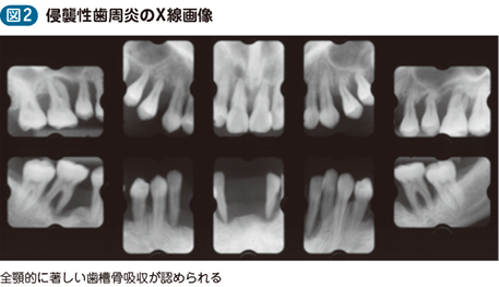 19_19_侵襲性歯周炎