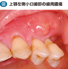 19_20_歯周膿瘍