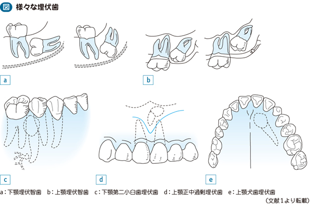 19_23_埋伏歯