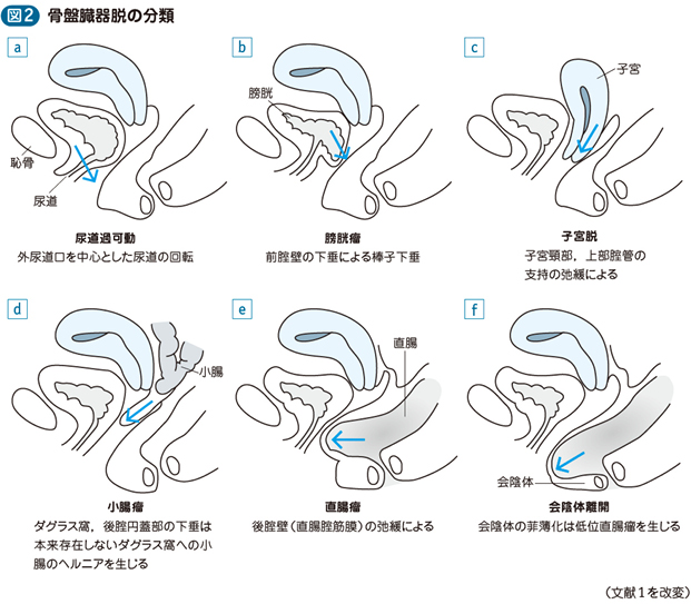 20_20_子宮脱（骨盤臓器脱）