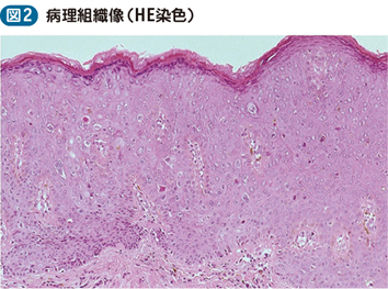 20_28_Bowen 病様丘疹症（Bowenoid papulosis）