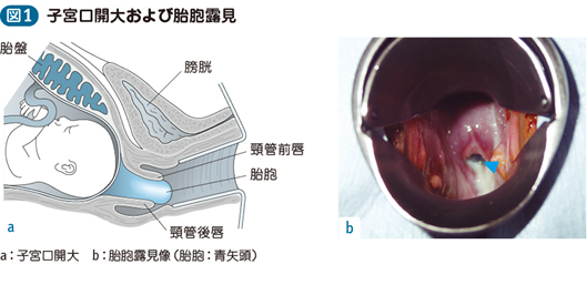 子宮 頸管 無力 症 症状