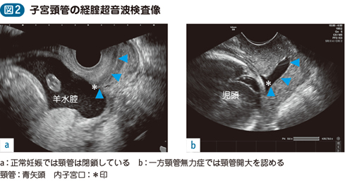 無力 症 頸管 症状 子宮 【産婦人科医監修】子宮頸管無力症の症状・原因・手術を解説！予防できるの？