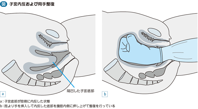 癒着胎盤 子宮内反症 電子コンテンツ 日本医事新報社