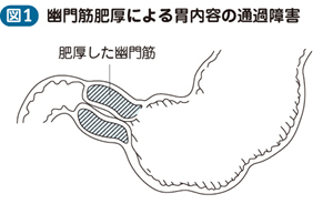 肥厚性幽門狭窄症 電子コンテンツ 日本医事新報社