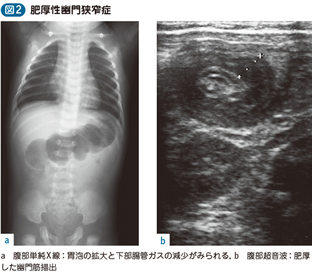 22_26_肥厚性幽門狭窄症