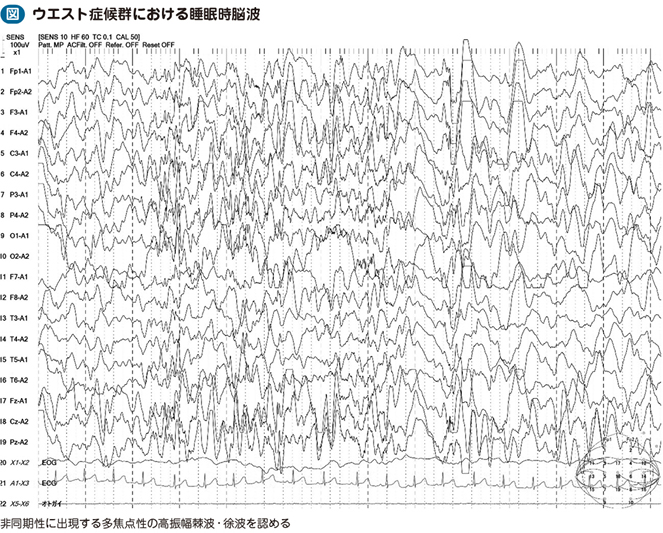 22_35_ウエスト症候群（点頭てんかん）